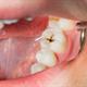 چه زمانی دندان پوسیده می‌شود؟ درمان و مراحل پوسیدگی دندان